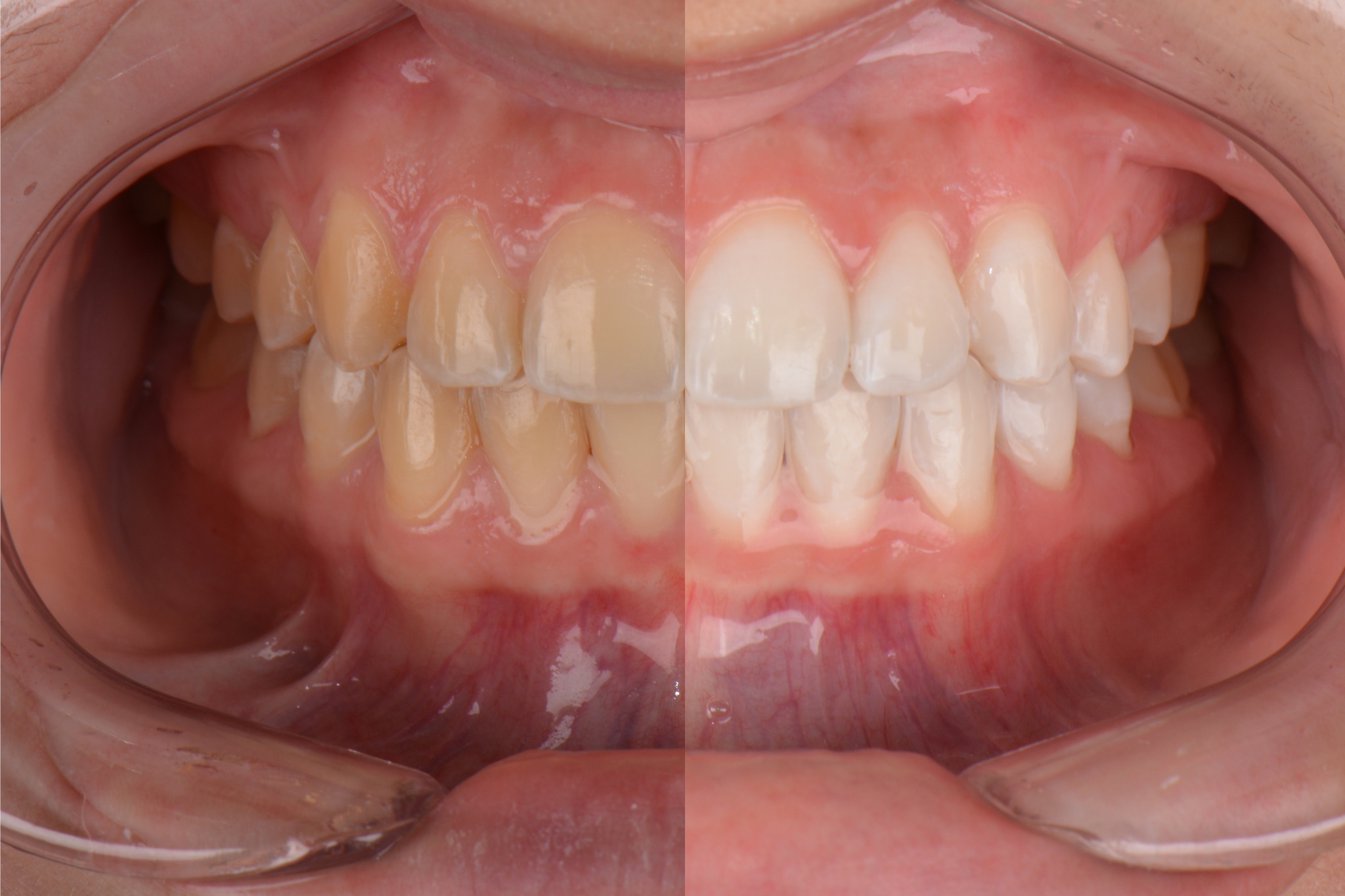 Blanqueamiento Dental
