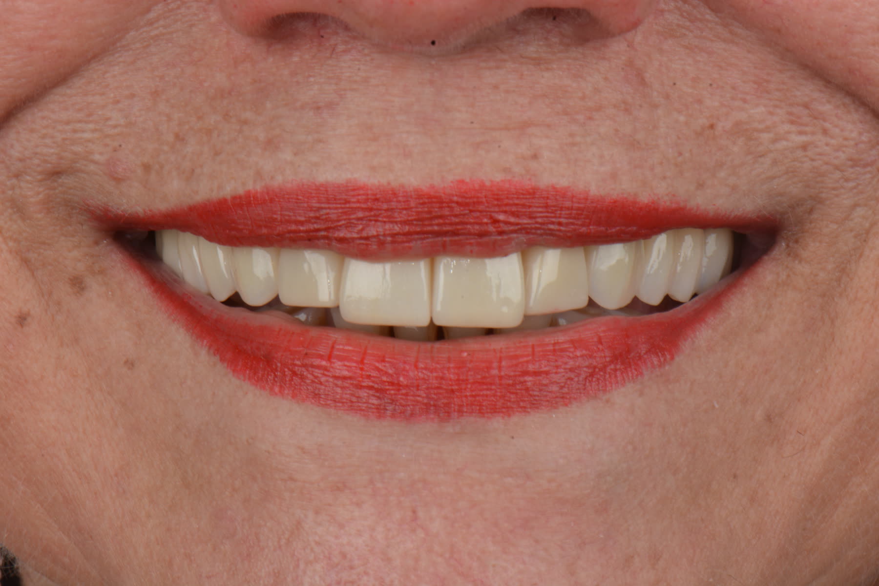 Implante Dental
